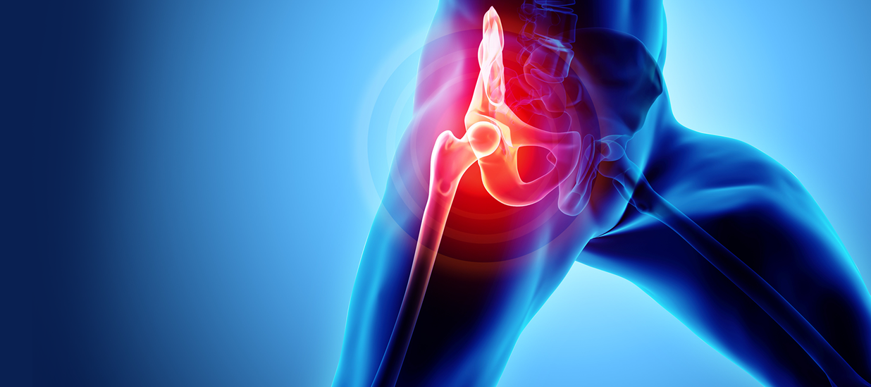 hip avascular necrosis Dubai