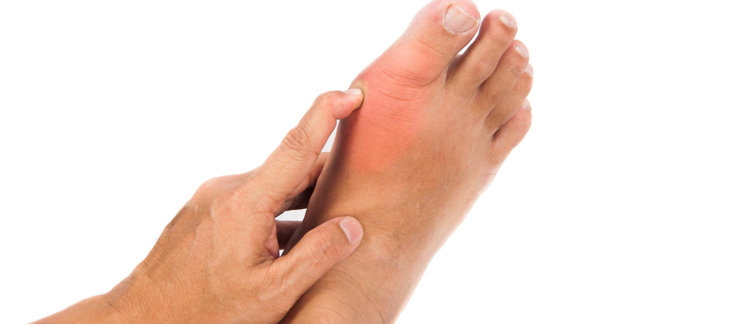 bunion treatment in Dubai