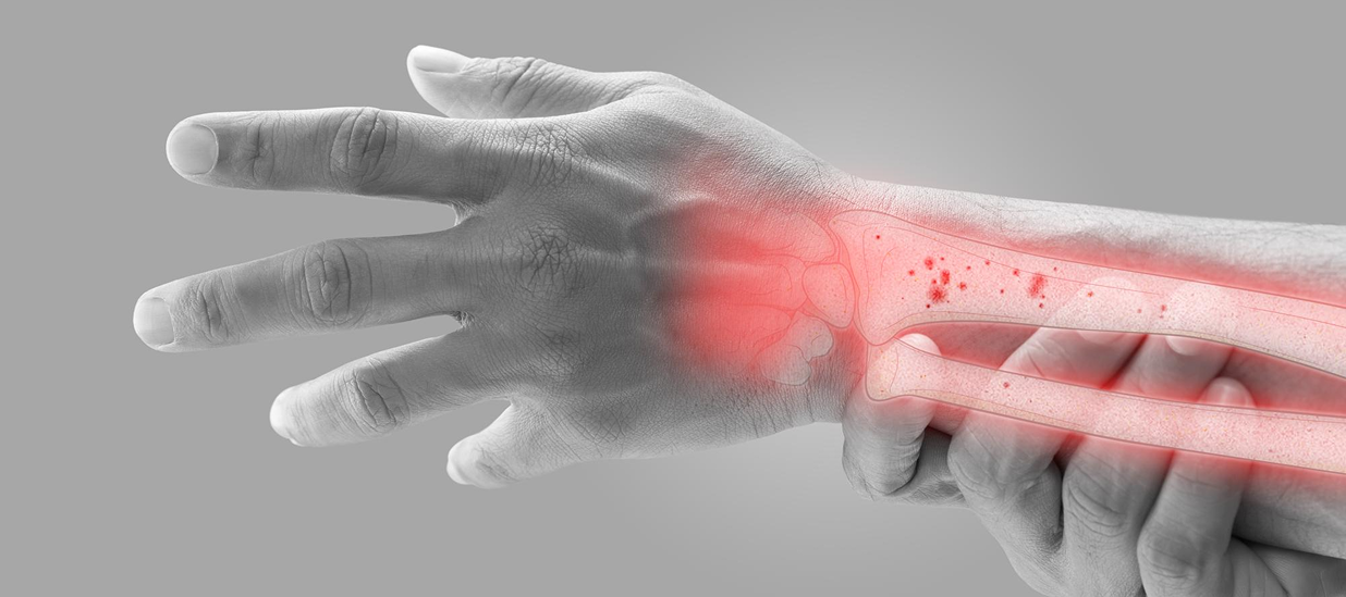 carpal tunnel syndrome treatment in Dubai