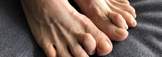 Hammer Toe