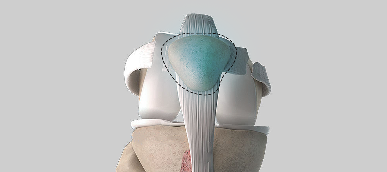 patellar instability treatment in Dubai