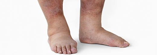 Diabetic foot