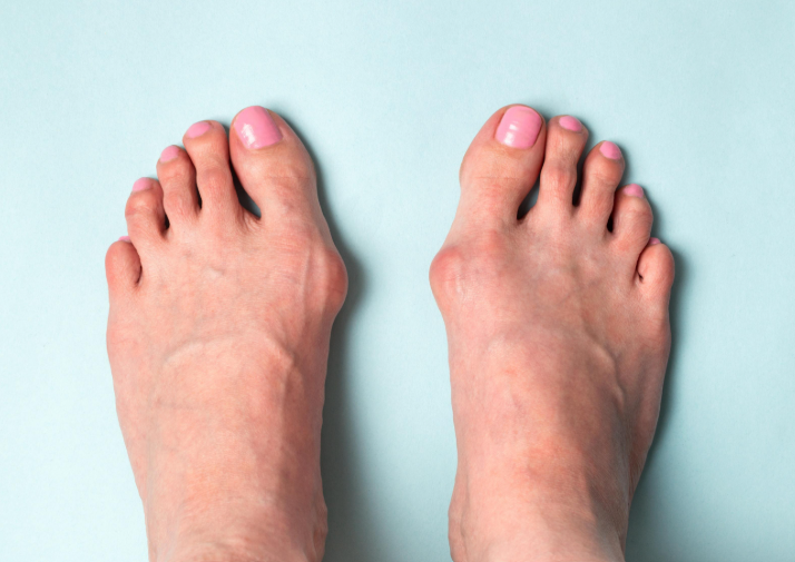 are bunions hereditary