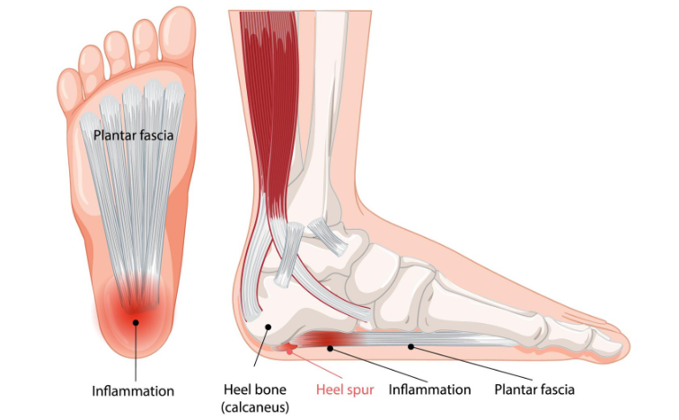 What is Plantar Fasciitis