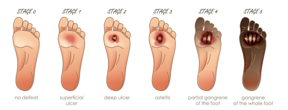 diabetic foot stages