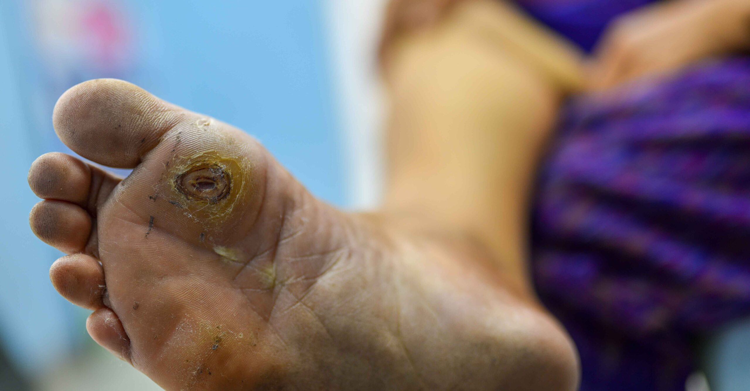 diabetic foot treatment in dubai