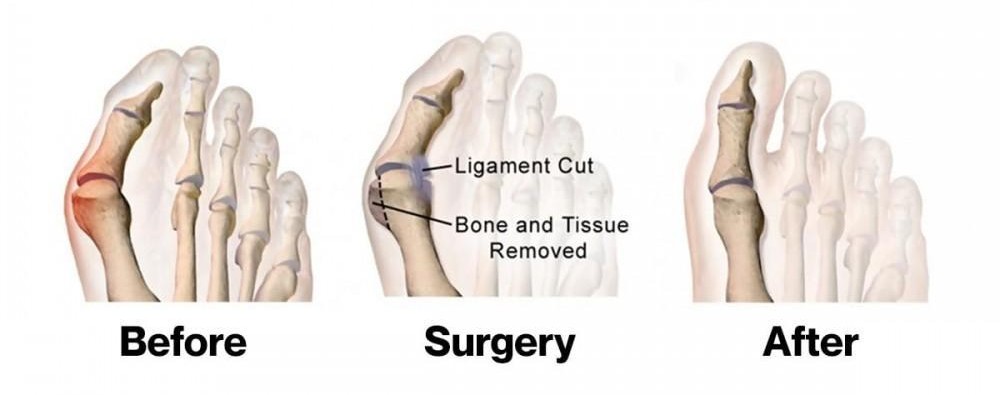 minimally invasive bunion surgery