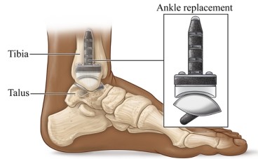 total ankle replacement