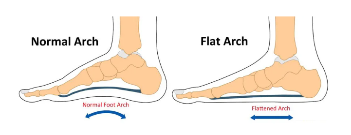 what is flat feet