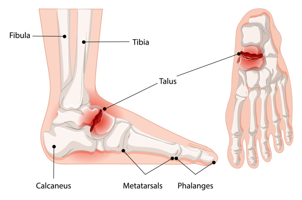 Symptoms of an Ankle Fracture