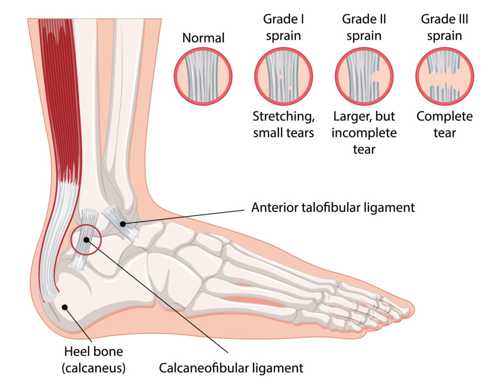 ankle sprain injury