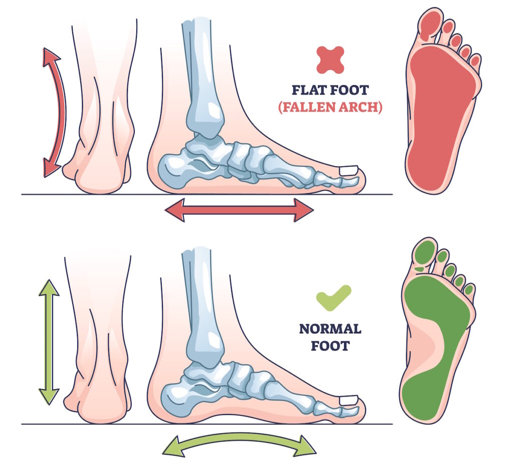 flat feet